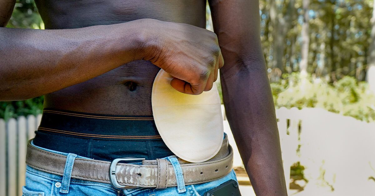 Colostomy Prolapse (Prolapsed Stoma) What to Know