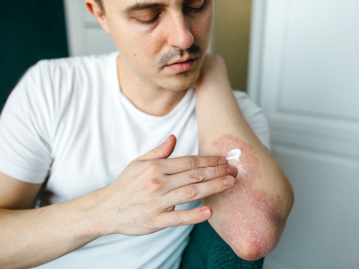 Plaque Psoriasis Treatment Options, Benefits, and Risks