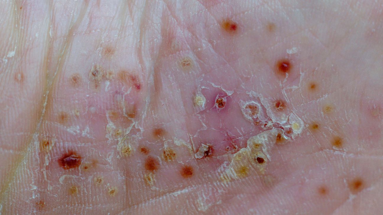 Pictures of Psoriasis and Eczema by Type, When to See a Doctor