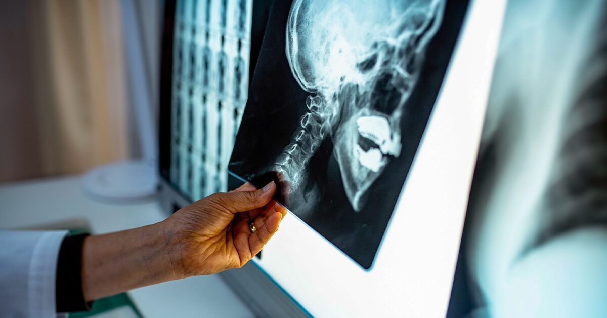 Bone Cancers of the Skull Symptoms, Treatment, Outlook