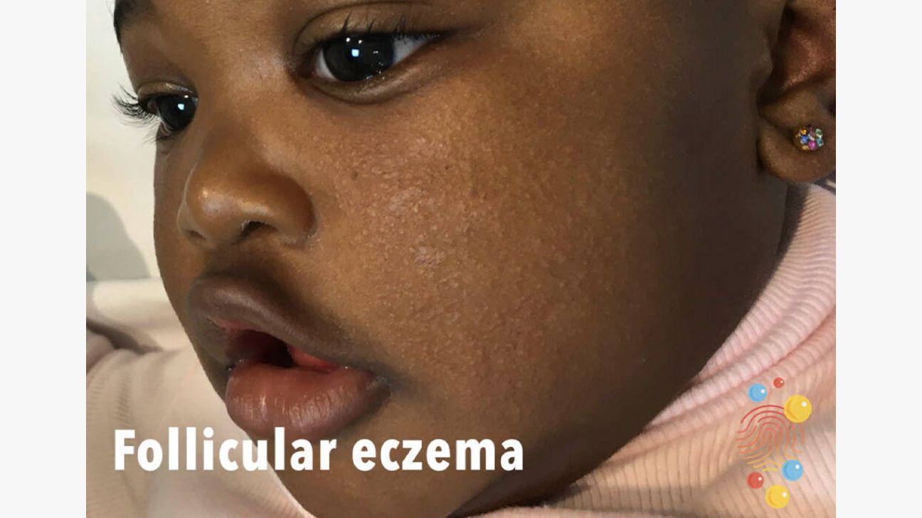 eczema baby face