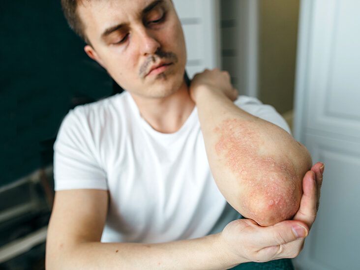 Quiz: How Much Do You Know About Psoriasis Triggers?