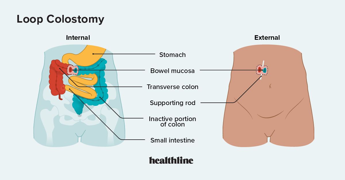 Loop Colostomy What You Should Know