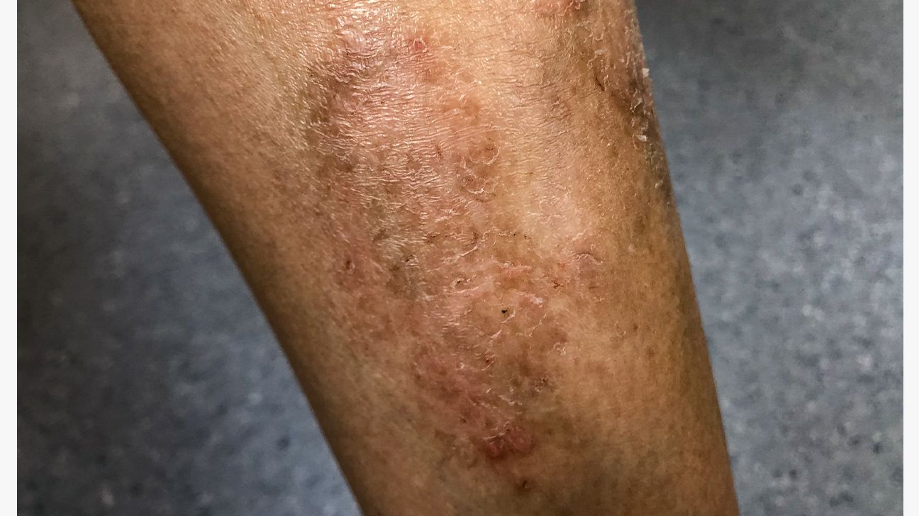 Close-up of skin with varicose veins on senior male leg. Concept of dry  skin, old senior people, varicose veins Stock Photo - Alamy