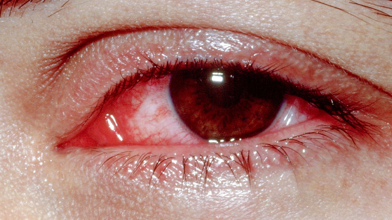 Knowing What Pink Eye Looks Like