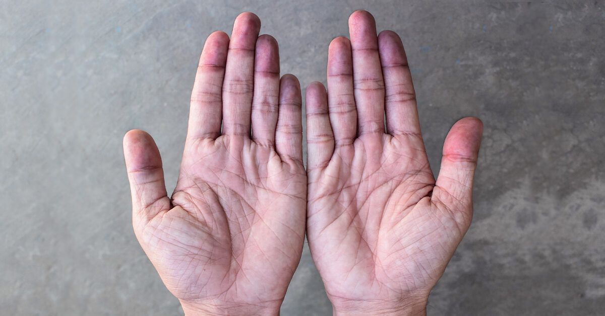 Why this man's skin turned blue