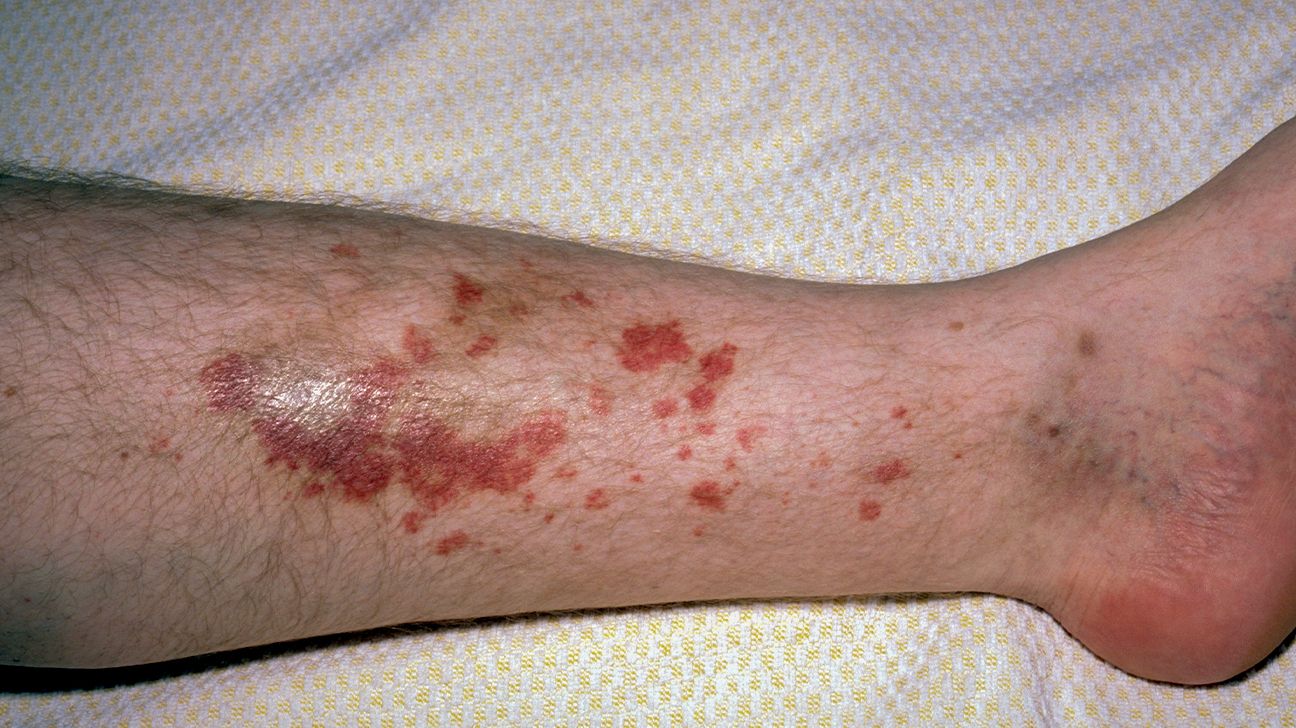 causes of rash purple