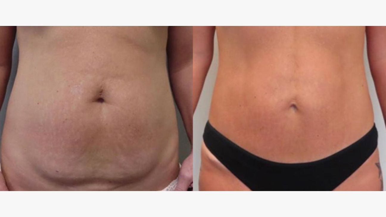 Tummy Tuck: Purpose, Procedure, Before and After Photos, and More