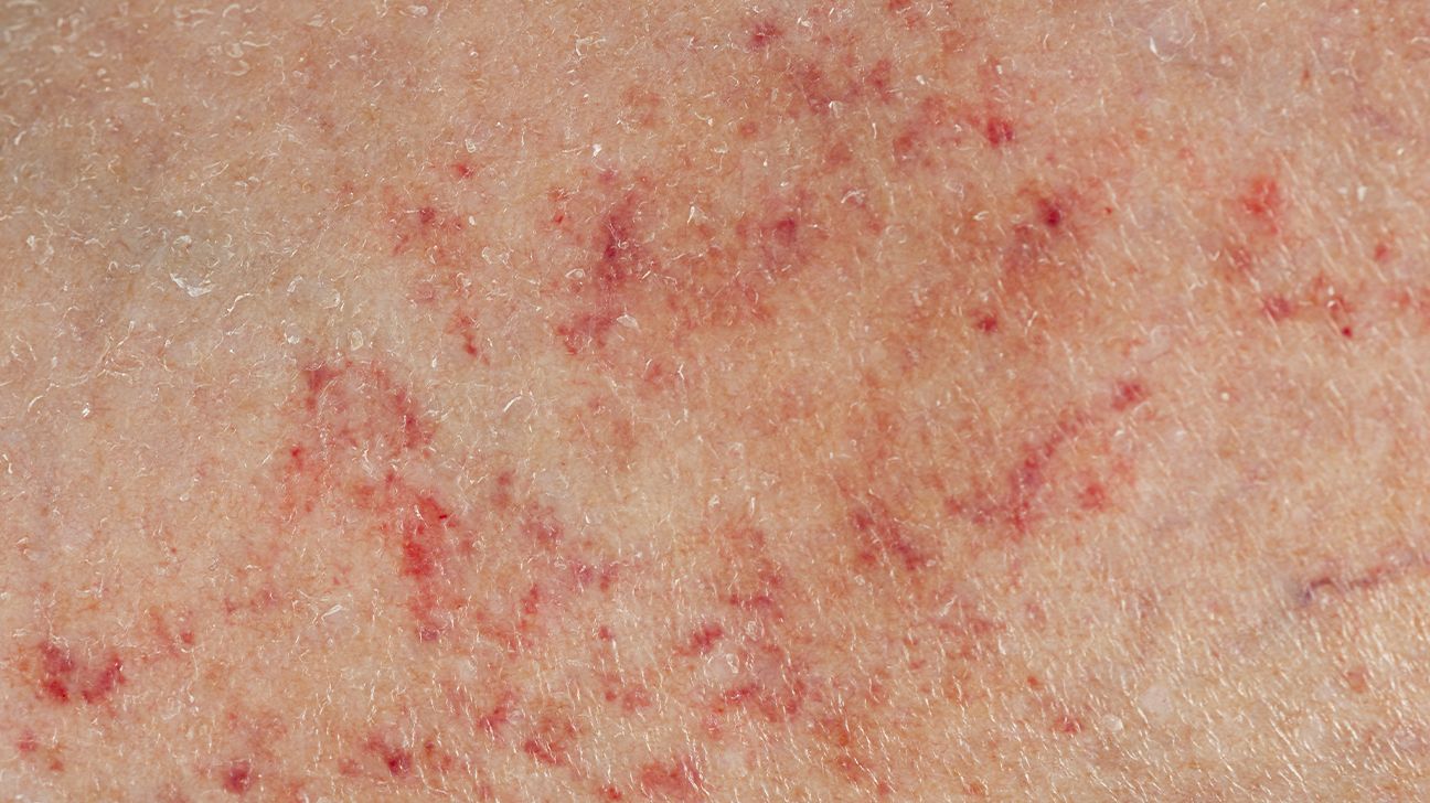 Whenever I'm feeling unwell, I develop a painless, flat, purple spot-like  rash on my thighs. What could this be? - Quora