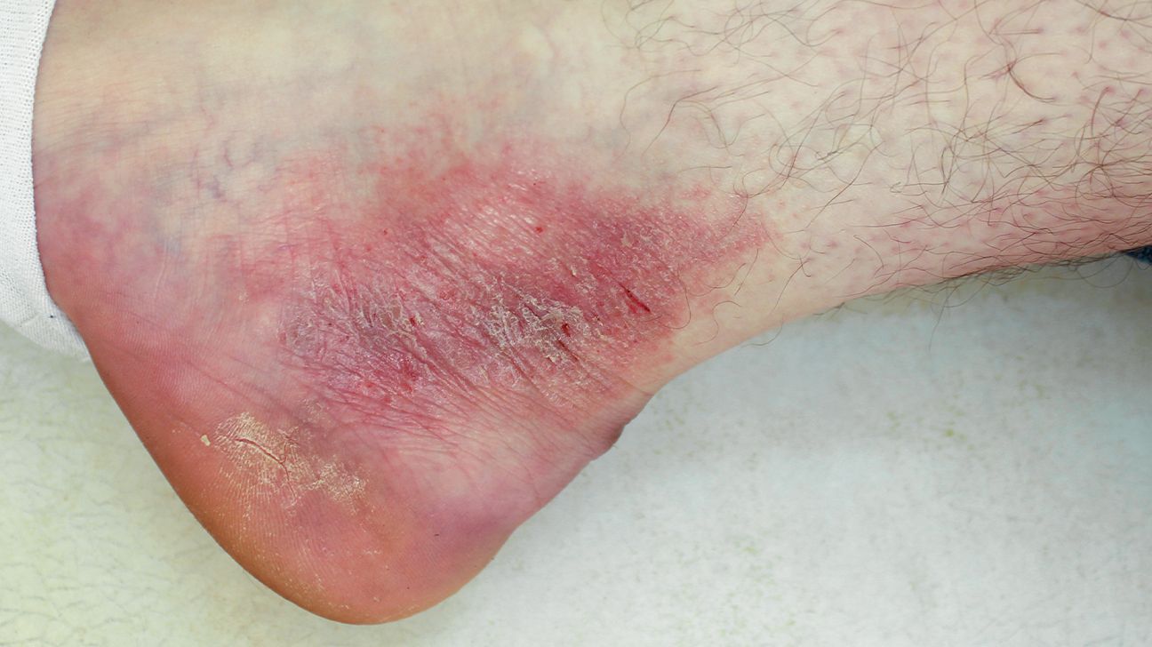 Pictures of Psoriasis and Eczema by Type, When to See a Doctor