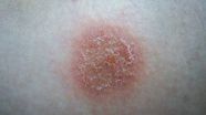 Psoriasis Discoid Dermatitis