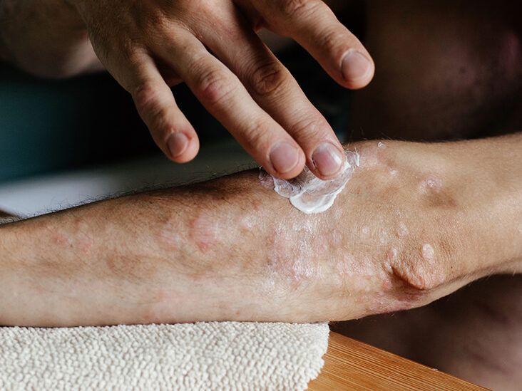 Your FAQs Answered: Psoriasis and Other Chronic Health Conditions