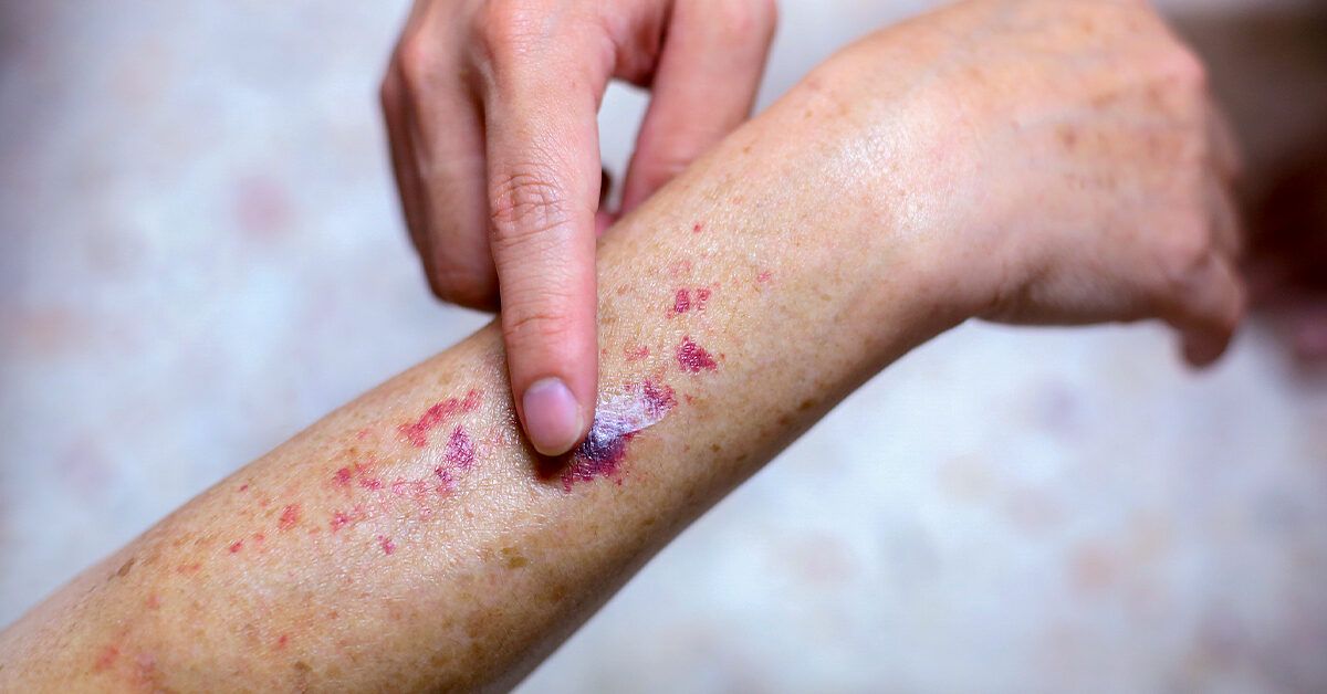 A man developed a rash that looked like something had scratched