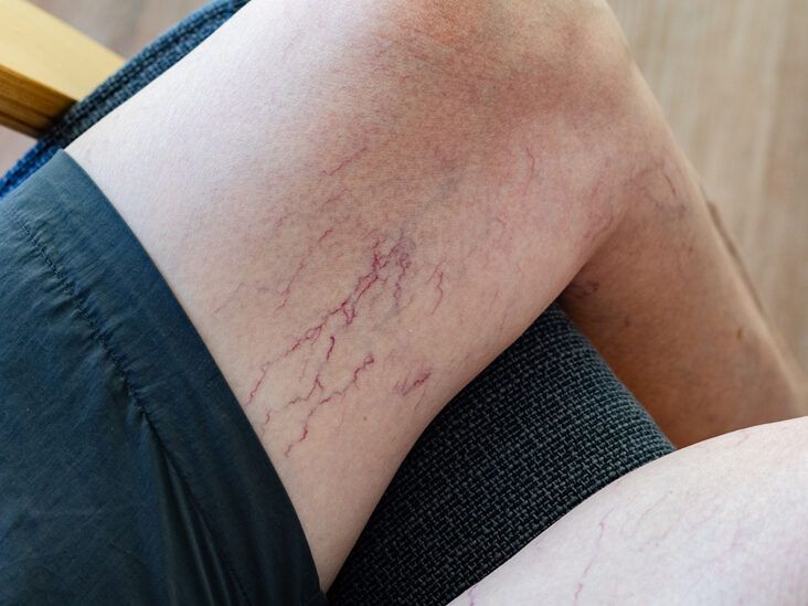 How to Get Rid of Spider Veins: Professional and Home Treatment