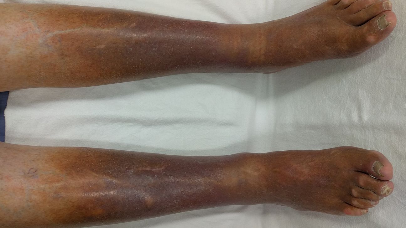 Fungal Infection in the Groin, Psoriasis, Dermatitis, Eczema. Stock Photo -  Image of dermatophytic, dermatitis: 140548058