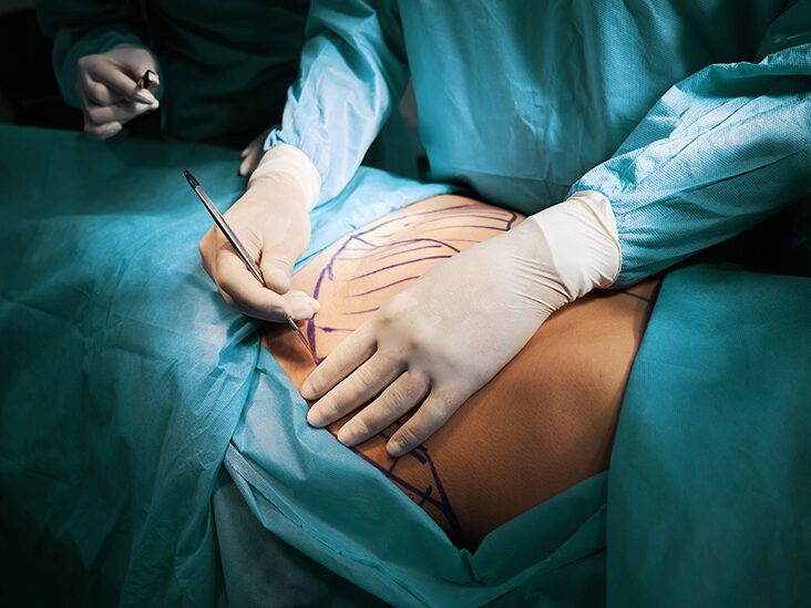 Mons Lift Turkey - Pubic fat liposuction (monsplasty) - Dr. Ali