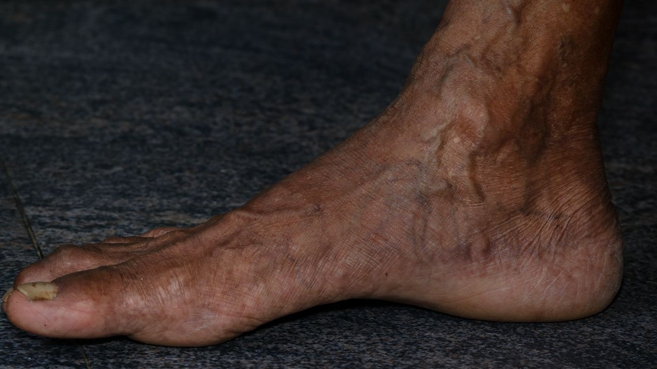 How to Treat Foot and Ankle Spider Veins