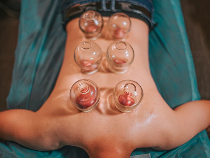 Cupping for Lower Back Pain, Does It Work?