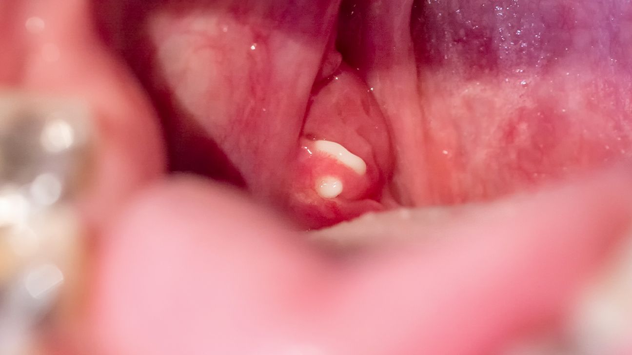 tonsil stone removal