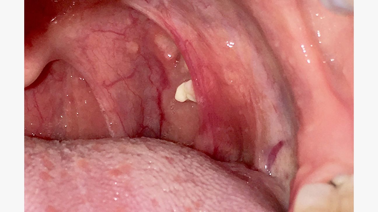 tonsil lump