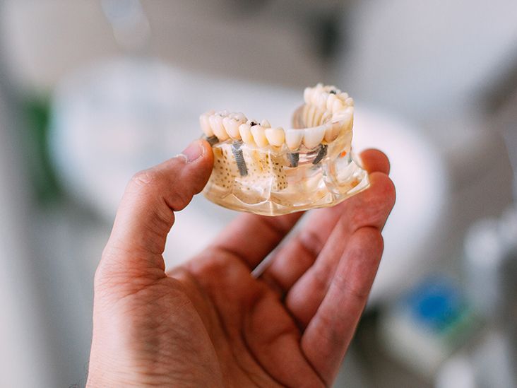 Dental Implants with Osteoporosis Are They Safe?