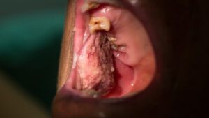 Can You Get Oral Cancer from Chewing Tobacco?