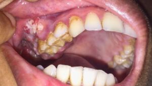 Can You Get Oral Cancer from Chewing Tobacco?