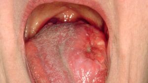 is chewing tobacco acidic or alkaline Simultaneous determination of areca nut- and tobacco-specific alkaloids in  saliva by LC-MS/MS: Distribution and transformation of alkaloids in oral  cavity