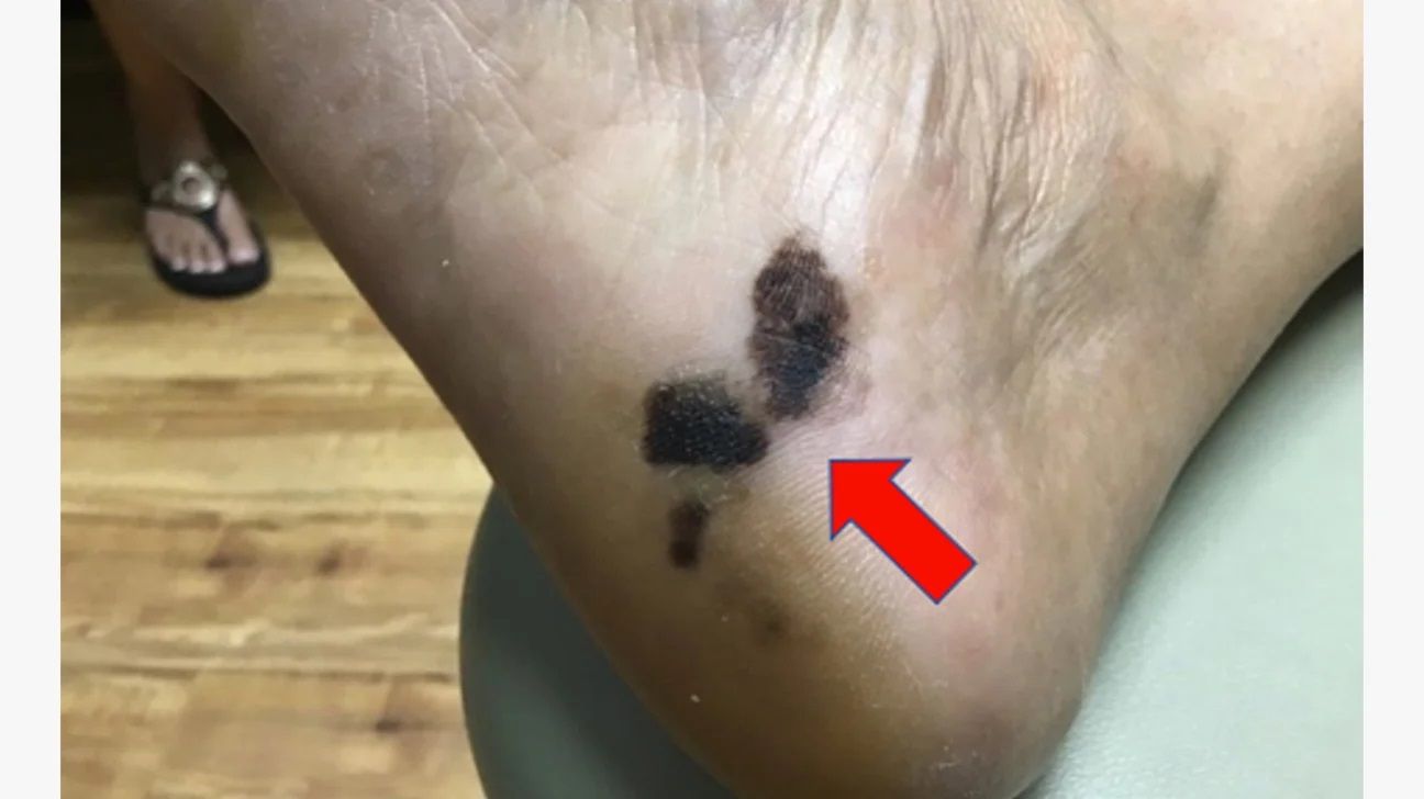 Acral lentiginous melanoma on darker skin