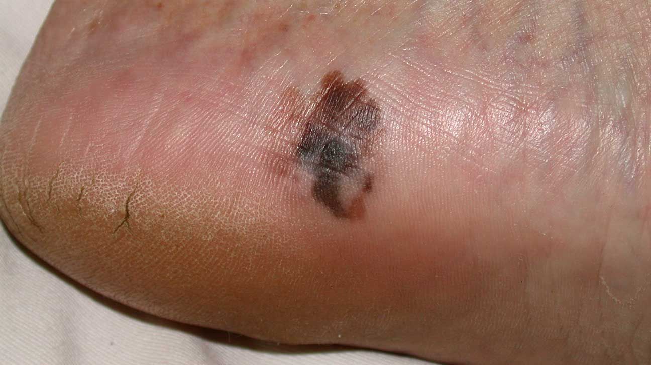 Acral lentiginous melanoma shown on a lighter skin tone. 