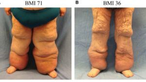 tirzepatide and surgery Restarting Tirzepatide After Surgery: Safety Guidelines and Timing tirzepatide and surgery Restarting Tirzepatide After Surgery: Safety Guidelines and Timing