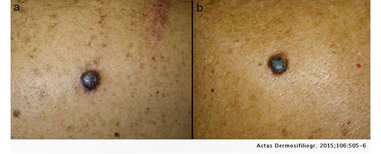 superficial spreading melanoma stages