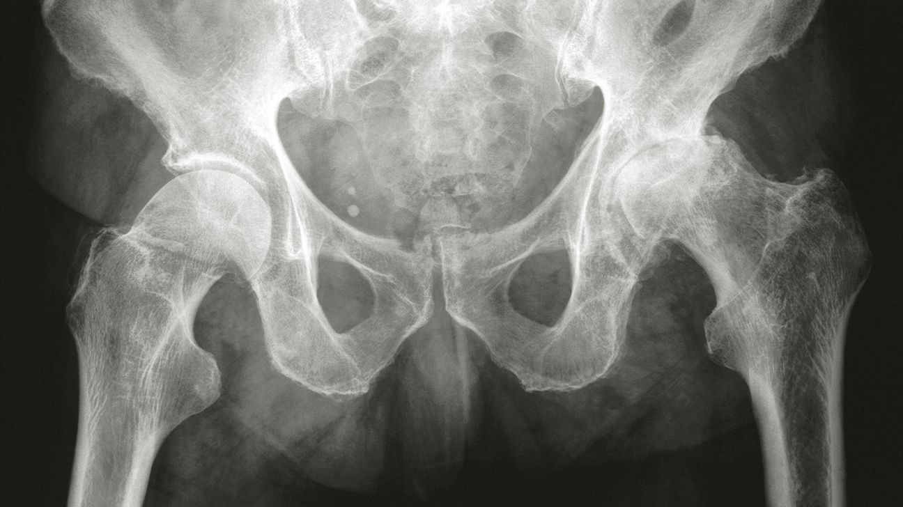 csípőröntgen, amely az ízületi tér szűkülését mutatja osteoarthritisben