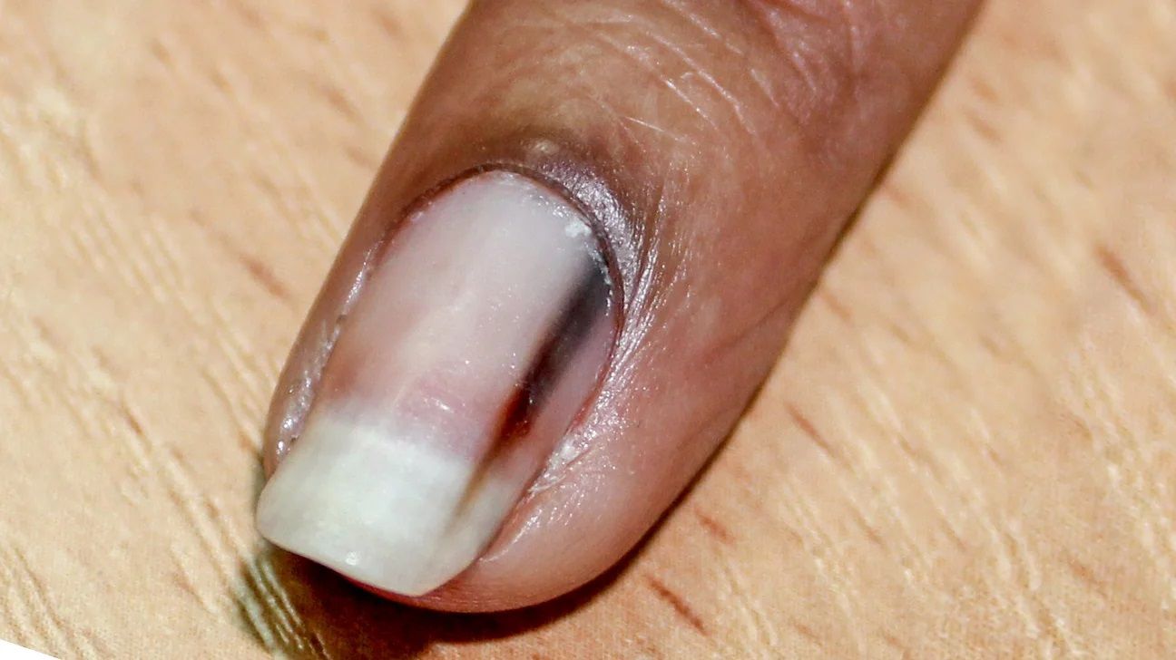 Woman's finger nail streak a symptom of subungual melanoma | news.com.au —  Australia's leading news site