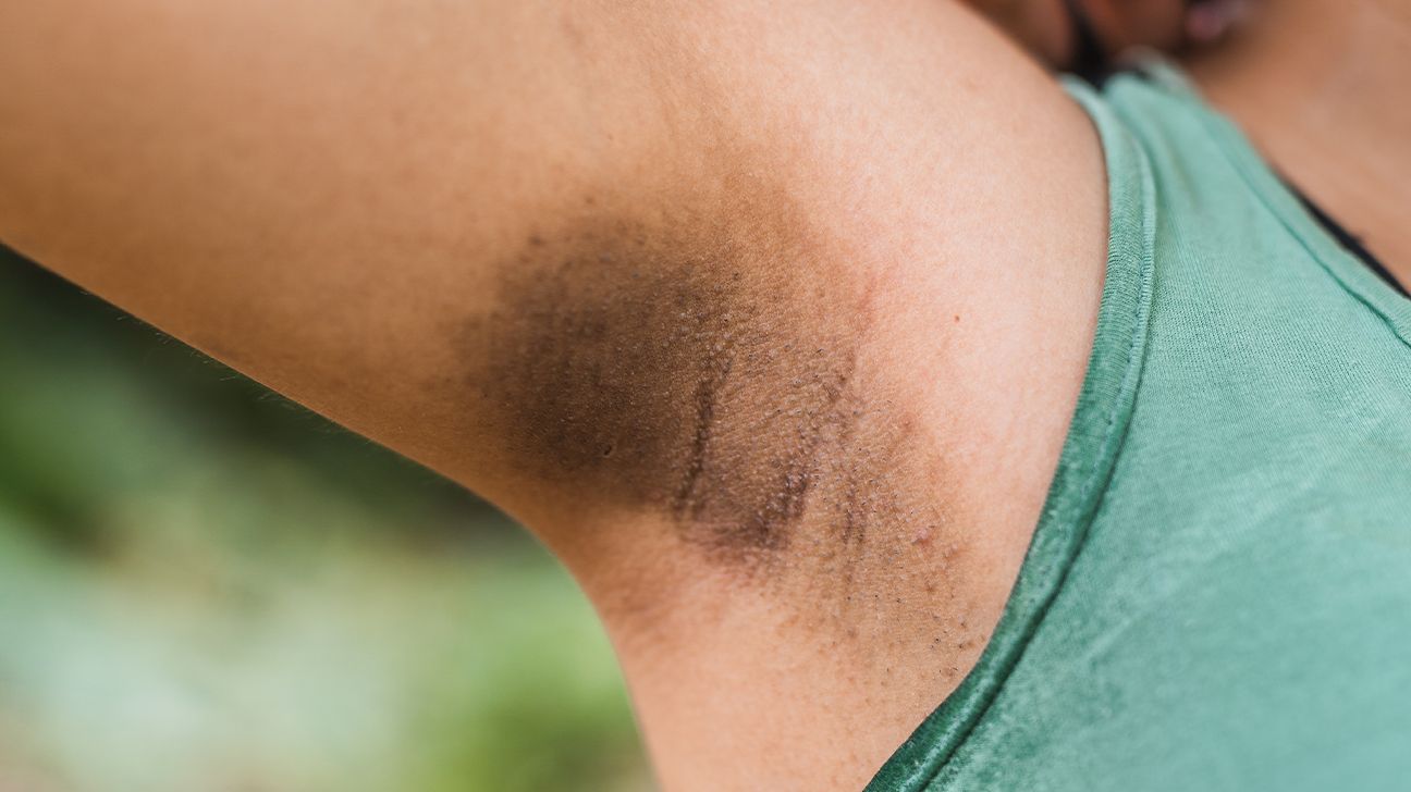 Armpit Rash: 14 Possible Causes and How to Treat Them