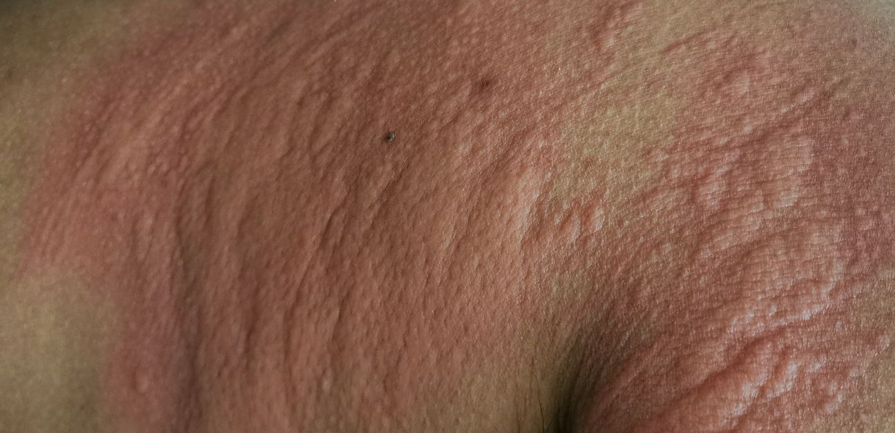 Itching In Armpits? Know These 6 Causes Of Armpit Rashes And Tips