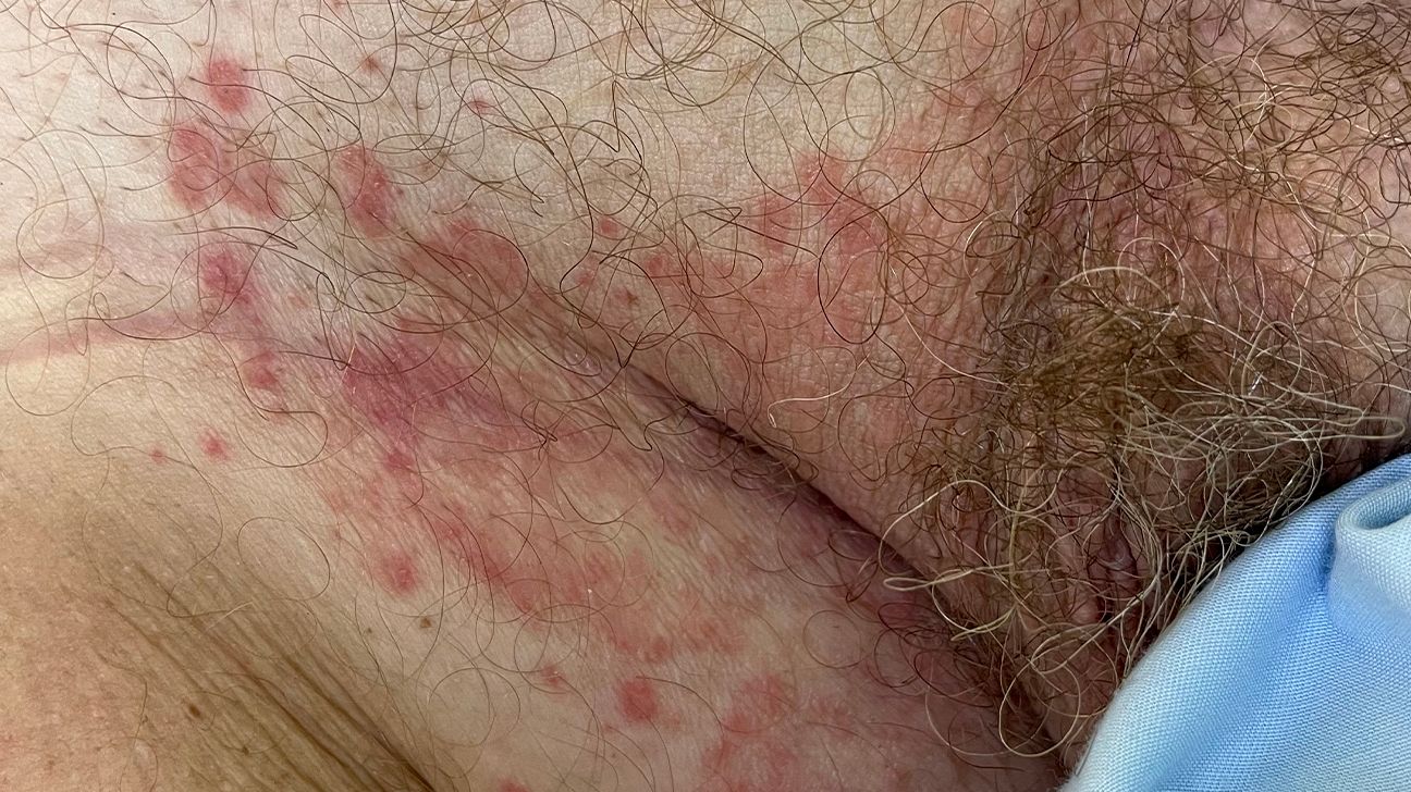 Managing Rash Under Breasts in Individuals with Diabetes