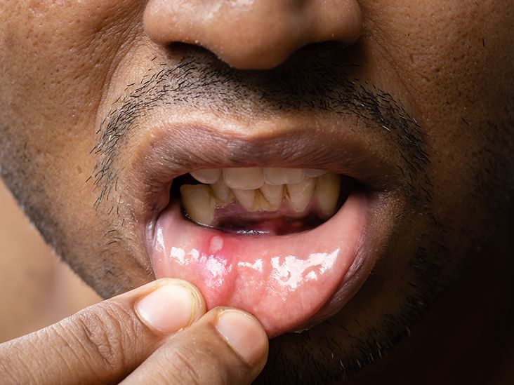 Cold sore on store roof of mouth