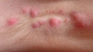 Sweat rash under arms discount