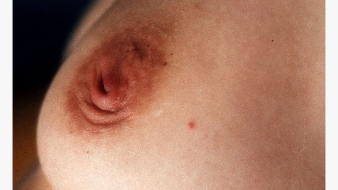 Itchiness In This Area Could Be A Sign Of Breast Cancer
