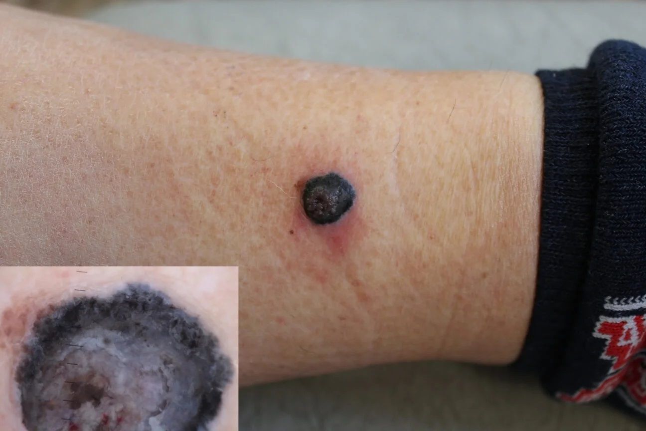 Nodular melanoma shown on lighter skin.