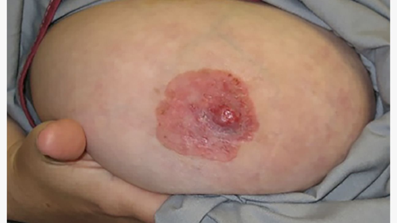 Skin diseases of the breast and nipple: Benign and malignant