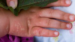 Recognizing Plants That Cause Hives or Other Reactions