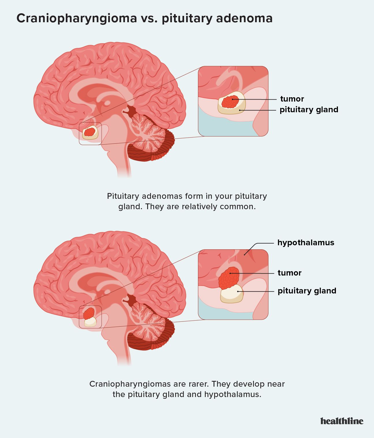 Ilustrație care compară un craniofaringiom cu un adenom hipofizar