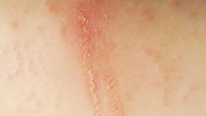 Scabs on Scalp: Everything You Need to Know - Wimpole Clinic
