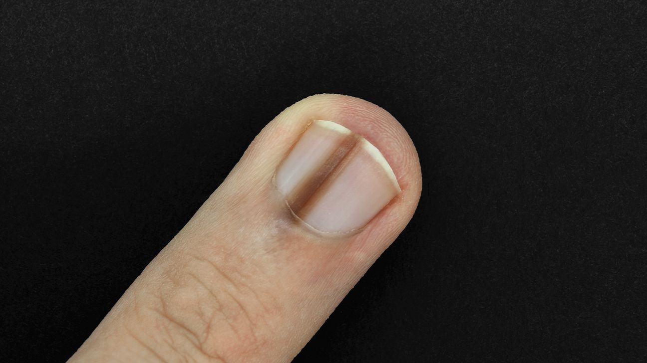 A woman said she thought the small dark spot underneath her toenail was a  mole. It turned out to be skin cancer. | Business Insider India