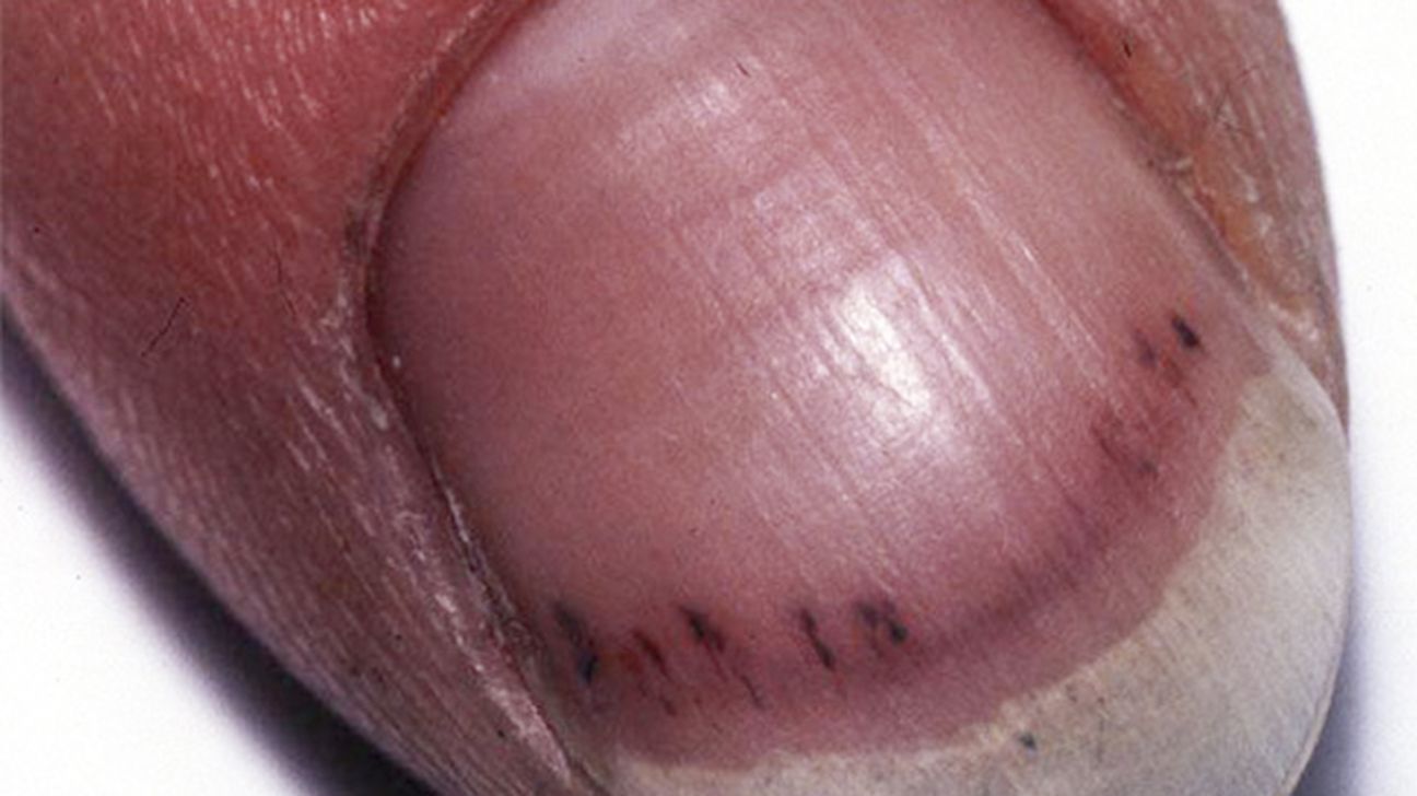 Evaluation of nail lines: Color and shape hold clues | Cleveland Clinic  Journal of Medicine