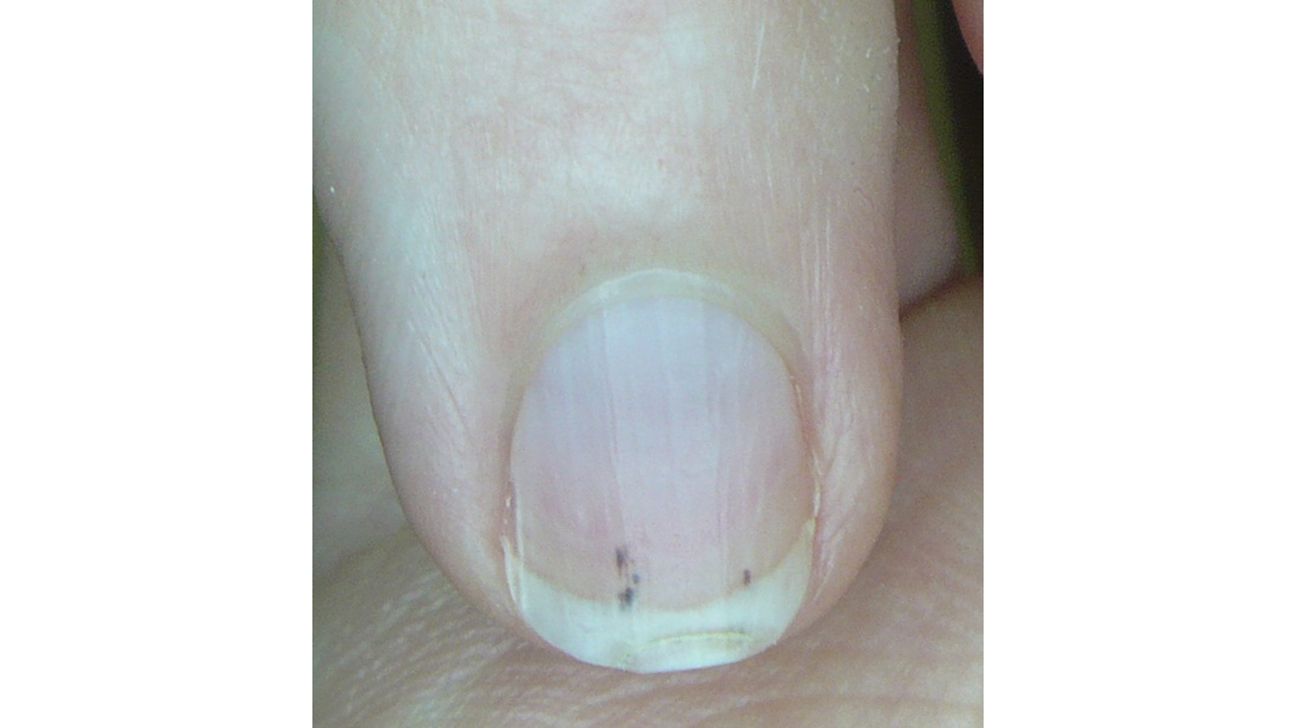 Black dot on toddler's nail? | BabyCenter