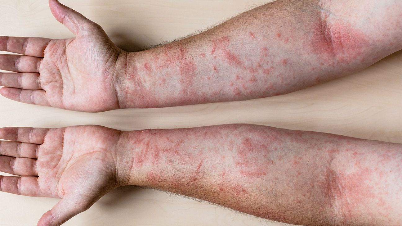 Contact dermatitis Information