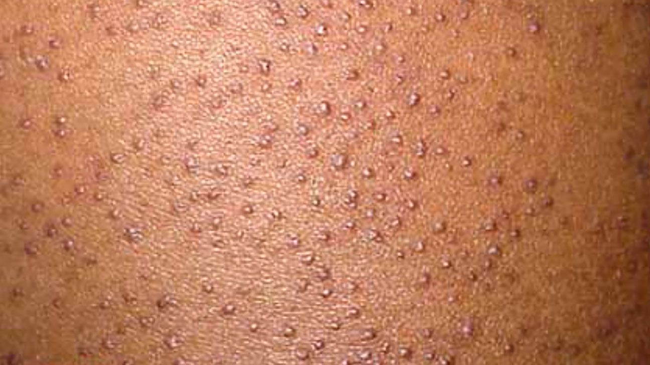 keratosis pilaris on black skin